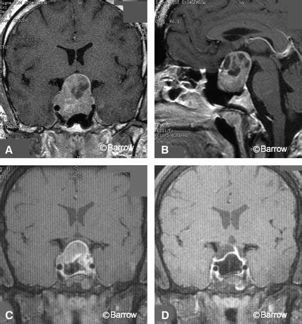 transseptal pituitary tumor treatment